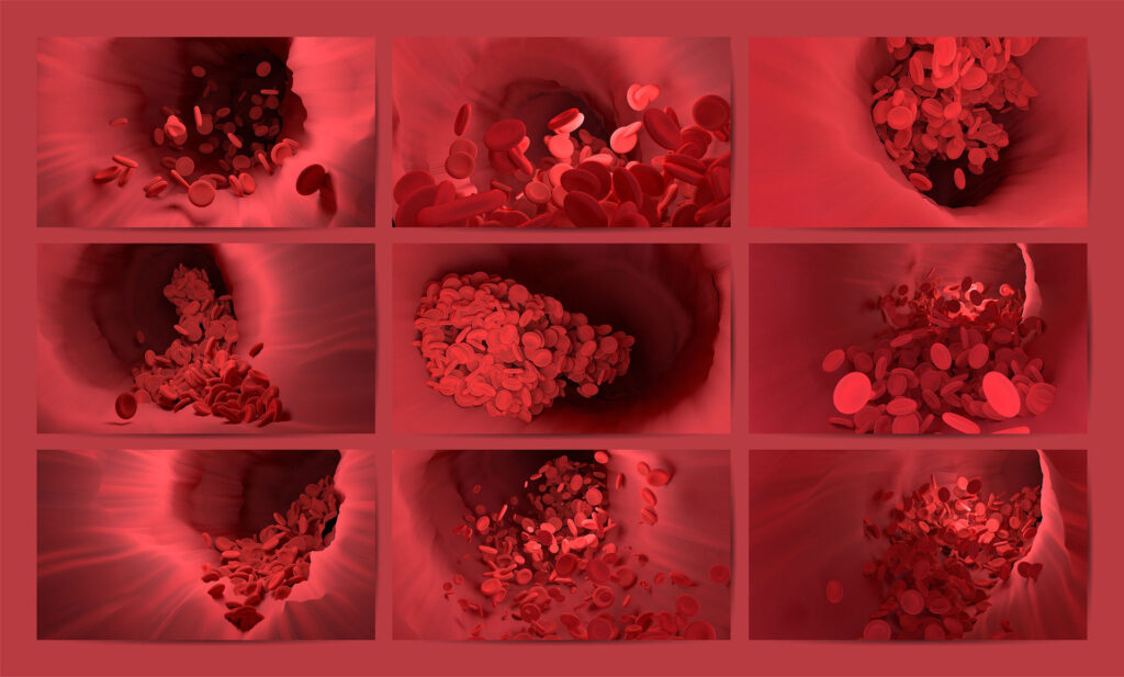 Thrombose / Thromboseprophylaxe